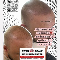 สักหัวล้านสักไรผม สักปิดรอยแผล SwanScalpHairlineCenter Bangkok