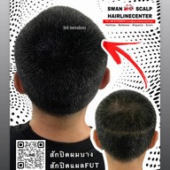 สักหัวล้านสักไรผม สักปิดรอยแผล SwanScalpHairlineCenter Bangkok