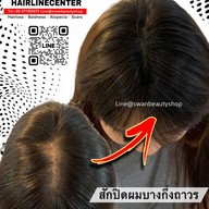 สักหัวล้านสักไรผม สักปิดรอยแผล SwanScalpHairlineCenter Bangkok