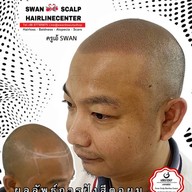 สักหัวล้านสักไรผม สักปิดรอยแผล SwanScalpHairlineCenter Bangkok