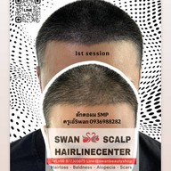 สักหัวล้านสักไรผม สักปิดรอยแผล SwanScalpHairlineCenter Bangkok