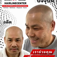 สักหัวล้านสักไรผม สักปิดรอยแผล SwanScalpHairlineCenter Bangkok