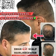 สักหัวล้านสักไรผม สักปิดรอยแผล SwanScalpHairlineCenter Bangkok