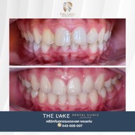 THE LAKE คลินิกทันตกรรม เดอะเลค ทำฟัน จัดฟัน วีเนียร์ รากเทียม รักษารากฟัน ฟอกสีฟัน ทำฟัน จัดฟัน- ขอนแก่น ศรีจันทร์