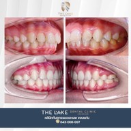 THE LAKE คลินิกทันตกรรม เดอะเลค ทำฟัน จัดฟัน วีเนียร์ รากเทียม รักษารากฟัน ฟอกสีฟัน ทำฟัน จัดฟัน- ขอนแก่น ศรีจันทร์