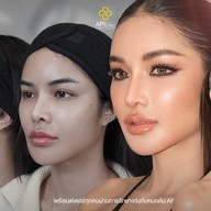 APi Clinic Surgery & Wellness เสริมจมูกเทคนิคเกาหลี by หมอต้น AF