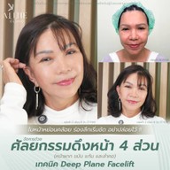 เมนูของร้าน ALINE Clinic by หมอภูวิช ดึงหน้า เสริมจมูกโอเพ่น ตาสองชั้น โคราช