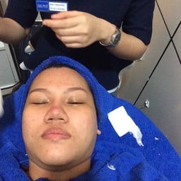  ดึงแผ่นสิวเสี้ยนออก