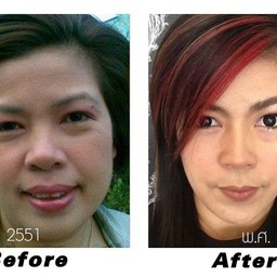 “Pro nong เคาะหน้า ลดกราม ปรับรูปหน้า ให้เป็น V reshaping Facae ”