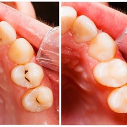 Dental Filling