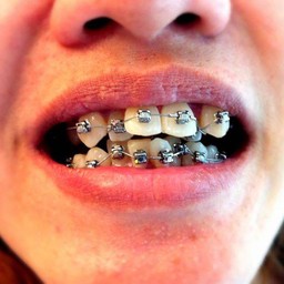 จัดฟันดาม่อน