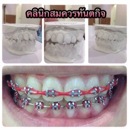 #จัดฟันปทุมธานี #คลินิกสมควรทันตกิจ ตัวเมืองปทุมธานี 0859959988