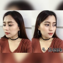 หลังฉีดโบท็อกซ์ Botulax 4 week