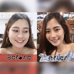 เทียบชัดๆ ก่อนทำ-หลังทำ โบท็อกซ์ Botulax ที่ Amed Clinic