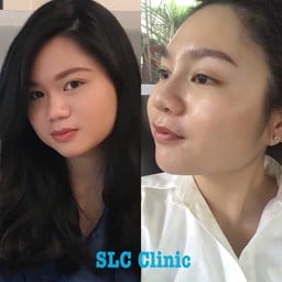 เสริมจมูก #หมออ้น #Slcclinic เปิดซิง รีวิว สวยๆๆๆคะ #SlcHopitol