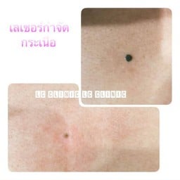 เลเซอร์ กำจัดกระเนื้อ ในบุรีรัมย์ แอลซีคลินิก