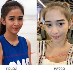 ฉีดผิวกับblossom clinic