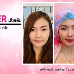 Filler เติมเต็มปากอวบอิ่ม น่าจุ๊ปๆๆ