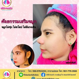 จมูกไม่พุง ไม่มีแรงเดิน