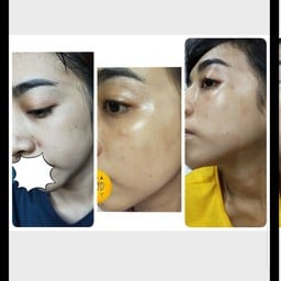 ฝ้าจางลงมากเลยคะ 