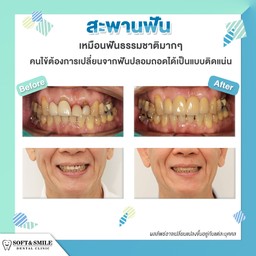 สะพานฟัน