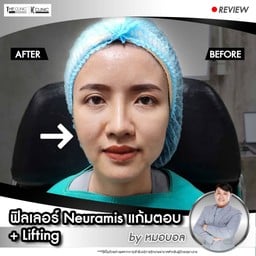 หน้ายก โดยใช้ฟิลเลอร์ ด้วยเทคนิคของคุณหมอบอล ไม่เจ็บค่ะ