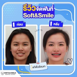 มีรีวิวอีกแล้วจ้าาา 😘 แก้ฟันซ้อนเกโดยคุณหมอชิ  คนไข้ยิ้มสวยน่ารักมากขึ้นมากๆเลย