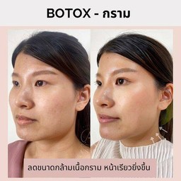Nabota โบท็อกเดียวในเกาหลีที่ได้รับการการันตีจากอเมริกา ตัวยาเสถียรลดอาการดื้อยา