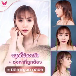 แก้จมูก สโลปปลายพุ่ง