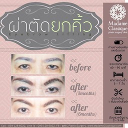 รีวิวผ่าตัดยกคิ้ว โดย อาจารย์หมอพูนพิศมัย