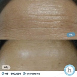 Review - Botulinum toxin 