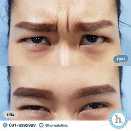 Review - Botulinum toxin 