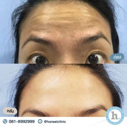 Review - Botulinum toxin 