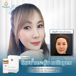ไหมน้ำ Ultracol บอกลาใต้ตาหมีแพนด้า
ริ้วรอยใต้ตา ตาหมองคล้ำ ใต้ตาฟูขึ้นและดูสดช