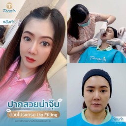 โปรแกรม Lip Filling เติมเต็มปากให้น่าจุ๊บ ปากสวยละมุน ตามแบบที่ต้องการ