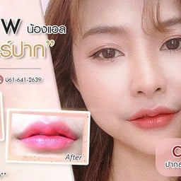 ฟิลเลอร์ปาก