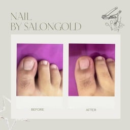 เล็บขบ #ร้านตัดเล็บขบ #ตัดเล็บขบ #ตัดเล็บขบบางนา #ตัดเล็บขบลาซาล #ตัดเล็บขบกรุงเ