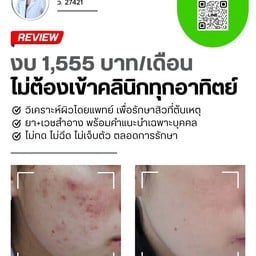 โปรแกรมรักษาสิวของมาลินีคลินิก ครบ คุ้ม จบ ในราคา 1,555 ต่อเดือ