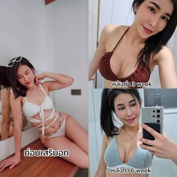 แพมเสริมหน้าอก Xtra gel กับคุณหมอบาส ที่ AM International Hospital 💖