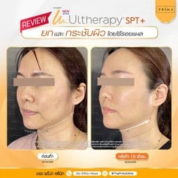 หลังทำอัลเทอร่ากับหมอช้อป 1 เดือนครึ่ง