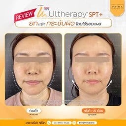 หลังทำอัลเทอร่ากับหมอช้อป 1 เดือนครึ่ง