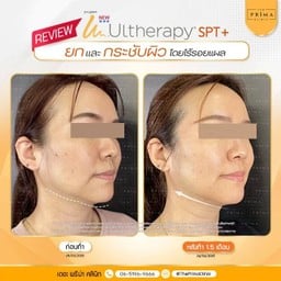 หลังทำอัลเทอร่ากับหมอช้อป 1 เดือนครึ่ง