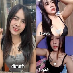 อุ้มเสริมหน้าอกที่ AM International Hospital ครบ 1 เดือน กับคุณหมอบาส

