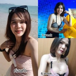 ลูกปัดเสริมหน้าอก 300cc ที่ AM International Hospital ครบ 3 เดือน กับคุณหมอบาส
