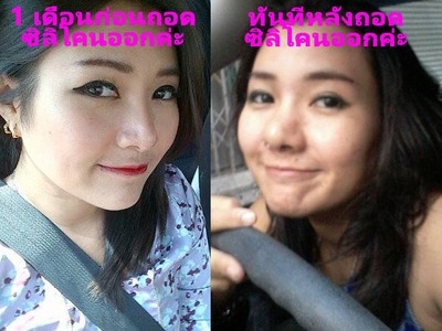 ก่อนและหลังถอดซิลิโคนจมูกออกค่ะ