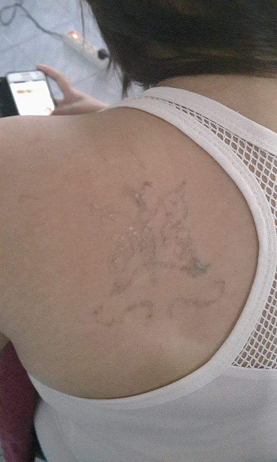 PM Tatoo Removel Laser