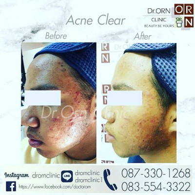 treat acne with Dr.orn the picture is only one session of treatment. Fantastic r