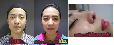 แก้จมูก+ตัดปีก