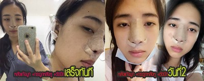 แก้จมูก+ตัดปีก