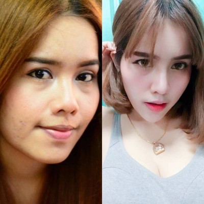 เสริมจมูก
